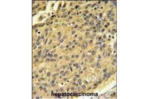 CTSH Antibody (N-term) (ABIN391569 and ABIN2841506) IHC analysis in formalin fixed and paraffin embedded human hepatocarcinoma followed by peroxidase conjugation of the secondary antibody and DAB staining. (Cathepsin H 抗体  (N-Term))