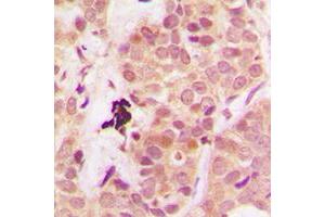 Immunohistochemical analysis of PTEN staining in human breast cancer formalin fixed paraffin embedded tissue section.