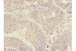 Immunohistochemistry of paraffin-embedded human endometrial cancer using ABIN7150598 at dilution of 1:100 (Ribophorin II 抗体  (AA 360-540))