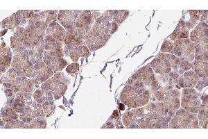 ABIN6273262 at 1/100 staining Human pancreas cancer tissue by IHC-P. (DHX58 抗体  (Internal Region))