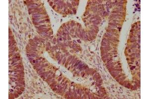 Immunohistochemical of paraffin-embedded human ovarian cancer using ABIN7153439 at dilution of 1:100 (Galectin 3 抗体)