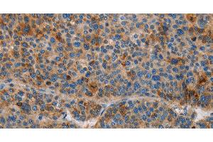 Immunohistochemistry of paraffin-embedded Human liver cancer using AMBP Polyclonal Antibody at dilution of 1:55 (AMBP 抗体)
