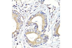 Immunohistochemistry of paraffin-embedded human colon carcinoma using HB-EGF antibody (ABIN7267617) at dilution of 1:100 (40x lens). (HBEGF 抗体  (AA 20-160))