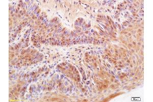 Formalin-fixed and paraffin embedded rat buccal mucosa cancer labeled with Anti-DKK3 Polyclonal Antibody, Unconjugated (ABIN749123) at 1:200 followed by conjugation to the secondary antibody and DAB staining (DKK3 抗体  (AA 31-130))