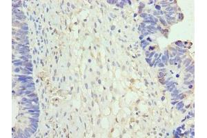Immunohistochemistry of paraffin-embedded human ovarian cancer using ABIN7161852 at dilution of 1:100 (NR2C2AP 抗体  (AA 7-139))