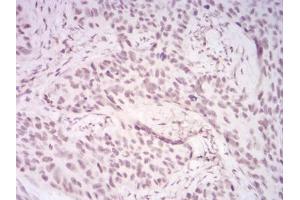 Immunohistochemical analysis of paraffin-embedded cervical cancer tissues using DDX39B mouse mAb with DAB staining. (DDX39B 抗体  (AA 1-250))