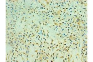 Immunohistochemistry of paraffin-embedded human breast cancer using ABIN7160859 at dilution of 1:100 (SIRT3 抗体  (AA 20-130))