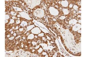 IHC-P Image Immunohistochemical analysis of paraffin-embedded OVCA xenograft, using 14-3-3 sigma, antibody at 1:100 dilution. (14-3-3 sigma/SFN 抗体)