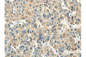 The image on the left is immunohistochemistry of paraffin-embedded Human liver cancer tissue using ABIN7190243(CHGB Antibody) at dilution 1/30, on the right is treated with synthetic peptide. (CHGB 抗体)