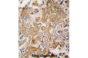 Formalin-fixed and paraffin-embedded human lung carcinomareacted with LECT1 polyclonal antibody , which was peroxidase-conjugated to the secondary antibody, followed by AEC staining. (LECT1 抗体  (C-Term))