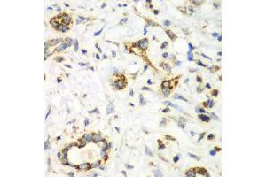 Immunohistochemistry of paraffin-embedded human liver cancer using NRBF2 antibody. (NRBF2 抗体)