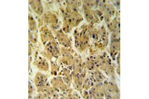 Immunohistochemistryanalysis in formalin fixed and paraffin embedded hepatocarcinoma reacted with NDUFS2 Antibody (Center) followed which was peroxidase conjugated to the secondary antibody and followed by DAB staining. (NDUFS2 抗体  (Middle Region))