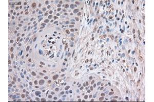Immunohistochemical staining of paraffin-embedded Adenocarcinoma of breast using anti-Trim33 (ABIN2452534) mouse monoclonal antibody (TRIM33 抗体  (AA 887-1046))