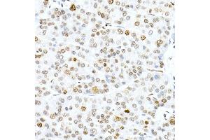 Immunohistochemistry of paraffin-embedded human liver cancer using Phospho-Histone H3. (Histone H3.3 抗体  (pSer31))