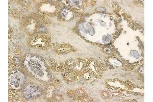 MGAT5 Mouse Monoclonal Antibody at 1/100 staining human ovarian cancer by IHC-P. (MGAT5 抗体)