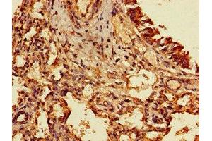 Immunohistochemistry of paraffin-embedded human lung cancer using ABIN7153207 at dilution of 1:100 (TIGAR 抗体  (AA 24-188))