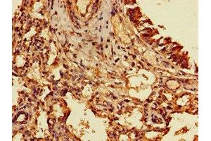 Immunohistochemistry of paraffin-embedded human lung cancer using ABIN7153207 at dilution of 1:100