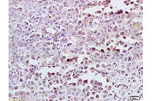Formalin-fixed and paraffin embedded mouse lymphoma tissue labeled with Anti-CDK4 Polyclonal Antibody (ABIN671166), Unconjugated at 1:300, followed by conjugation to the secondary antibody and DAB staining (CDK4 抗体  (AA 241-303))