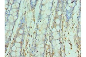 Immunohistochemistry of paraffin-embedded human colon cancer using ABIN7171146 at dilution of 1:100 (SNAP25 抗体  (AA 1-206))