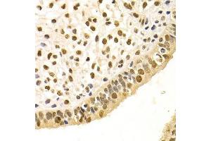 Immunohistochemistry of paraffin-embedded human uterine cancer using DDB1 Antibody. (DDB1 抗体)