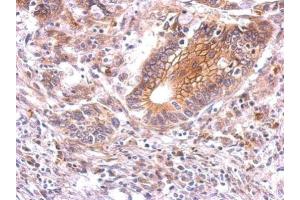 IHC-P Image beta Catenin antibody detects CTNNB1 protein at membrane on human gastric cancer by immunohistochemical analysis. (CTNNB1 抗体)