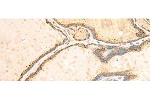 Immunohistochemistry of paraffin-embedded Human thyroid cancer tissue using IGFBPL1 Polyclonal Antibody at dilution of 1:55(x200) (IGFBPL1 抗体)