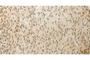 Immunohistochemistry of paraffin-embedded Human cervical cancer using MYSM1 Polyclonal Antibody at dilution of 1:60 (MYSM1 抗体)