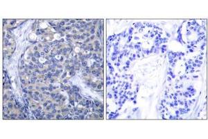 Immunohistochemical analysis of paraffin-embedded human breast carcinoma tissue, using Zap-70 (Ab-319) antibody (E021173). (ZAP70 抗体)