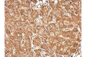 IHC-P Image HACL1 antibody detects HACL1 protein at cytosol on human hepatoma by immunohistochemical analysis. (HACL1 抗体  (C-Term))