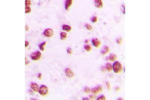 Immunohistochemical analysis of Artemis (pS516) staining in human lung cancer formalin fixed paraffin embedded tissue section. (DCLRE1C 抗体  (pSer516))