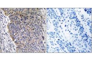 Immunohistochemistry analysis of paraffin-embedded human lung carcinoma tissue, using MGST3 Antibody. (MGST3 抗体  (AA 8-57))