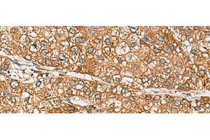 Immunohistochemistry of paraffin-embedded Human liver cancer tissue using DCAF12 Polyclonal Antibody at dilution of 1:65(x200) (DCAF12 抗体)