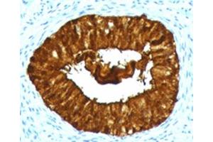 IHC testing of FFPE human cervical carcinoma with MAML3 antibody (clone MMLP3-1). (MAML3 抗体)
