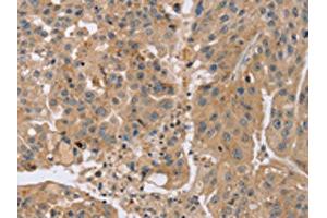 The image on the left is immunohistochemistry of paraffin-embedded Human breast cancer tissue using ABIN7191184(KCNJ15 Antibody) at dilution 1/35, on the right is treated with synthetic peptide. (KCNJ15 抗体)