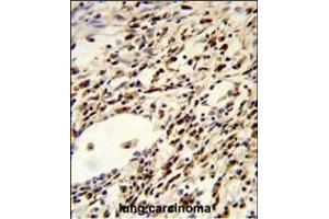 Formalin-fixed and paraffin-embedded human lung carcinoma reacted with FLCN Antibody (Center), which was peroxidase-conjugated to the secondary antibody, followed by DAB staining. (FLCN 抗体  (AA 325-354))