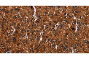 Immunohistochemistry of paraffin-embedded Human liver cancer tissue using RTN4R Polyclonal Antibody at dilution 1:50 (RTN4R 抗体)