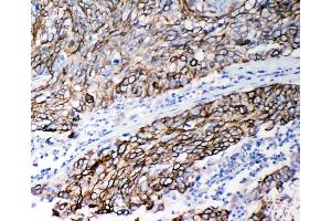 Anti-Stefin B antibody, IHC(P) IHC(P): Human Lung Cancer Tissue (CSTB 抗体  (Middle Region))