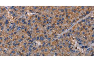 Immunohistochemistry of paraffin-embedded Human liver cancer using NUP62 Polyclonal Antibody at dilution of 1:40 (NUP62 抗体)