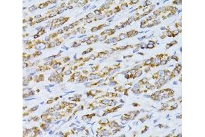 Immunohistochemistry of paraffin-embedded Human colon carcinoma using CCDC92 Polyclonal Antibody at dilution of 1:100 (40x lens). (CCDC92 抗体)