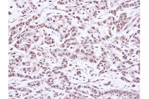 IHC-P Image Immunohistochemical analysis of paraffin-embedded A549 Xenograft, using SMC1A, antibody at 1:100 dilution. (SMC1A 抗体  (N-Term))