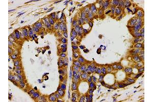 ABIN6267452 at 1/200 staining human colon cancer tissue sections by IHC-P. (PIK3R1 抗体  (pTyr607))