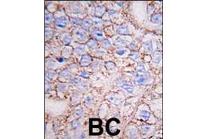 Formalin-fixed and paraffin-embedded human breast carcinoma tissue reacted with ERK8 antibody (N-term), which was peroxidase-conjugated to the secondary antibody, followed by DAB staining.