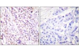 Immunohistochemistry analysis of paraffin-embedded human breast carcinoma tissue, using RAD17 (Ab-645) Antibody. (RAD17 抗体  (AA 621-670))