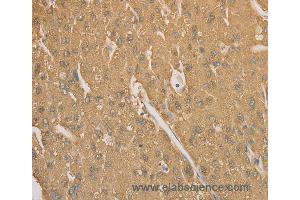 Immunohistochemistry of Human gastric cancer using CD40 Polyclonal Antibody at dilution of 1:70 (CD40 抗体)