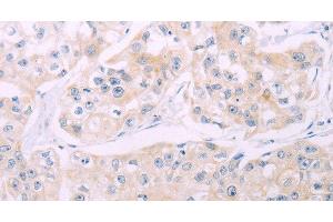 Immunohistochemistry of paraffin-embedded Human breast cancer tissue using ADCY7 Polyclonal Antibody at dilution 1:60 (ADCY7 抗体)