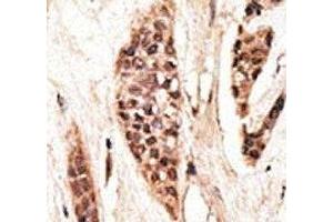 IHC analysis of FFPE human breast carcinoma tissue stained with the TAP1 antibody (TAP1 抗体  (AA 765-794))
