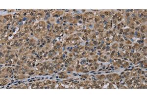 Immunohistochemistry of paraffin-embedded Human thyroid cancer tissue using NLRP6 Polyclonal Antibody at dilution 1:50 (NLRP6 抗体)