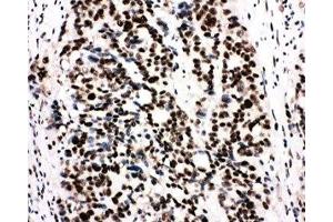 IHC-P: Ku80 antibody testing of human breast cancer tissue (XRCC5 抗体  (C-Term))