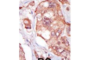 Formalin-fixed and paraffin-embedded human cancer tissue reacted with the primary antibody, which was peroxidase-conjugated to the secondary antibody, followed by AEC staining. (TNK1 抗体  (AA 256-286))