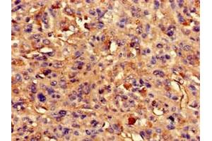 Immunohistochemistry of paraffin-embedded human melanoma using ABIN7144568 at dilution of 1:100 (ARAP3 抗体  (AA 163-320))
